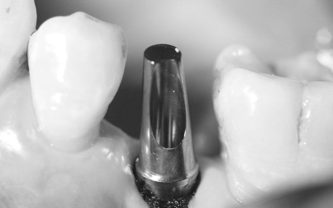 Angled Abutments