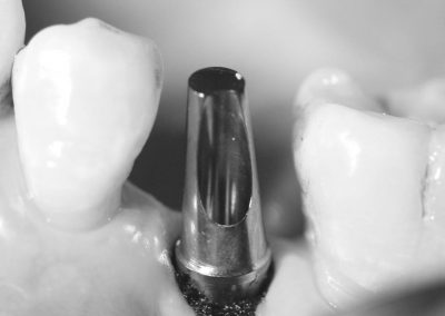 Angled Abutments