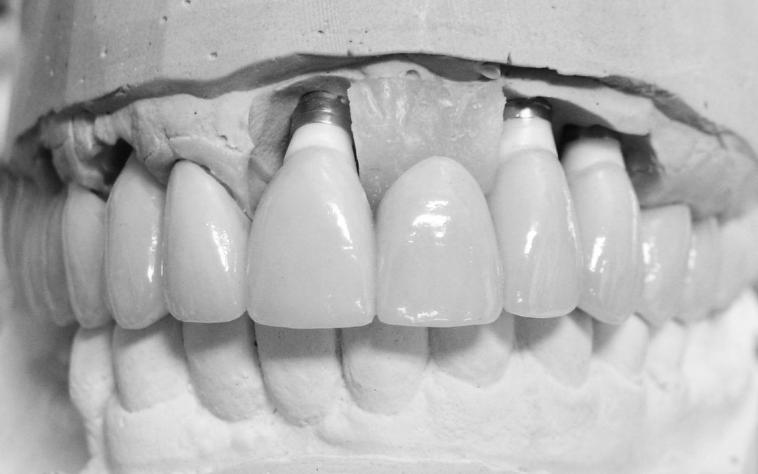 Custom Abutments
