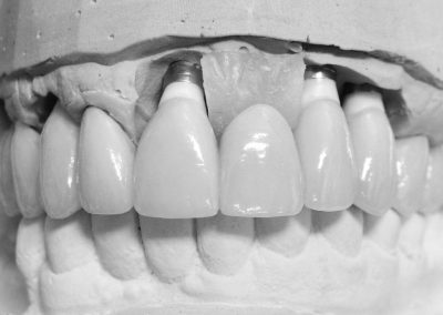 Custom Abutments