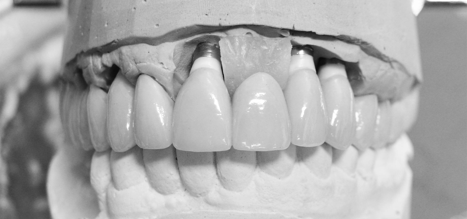 Custom Abutments