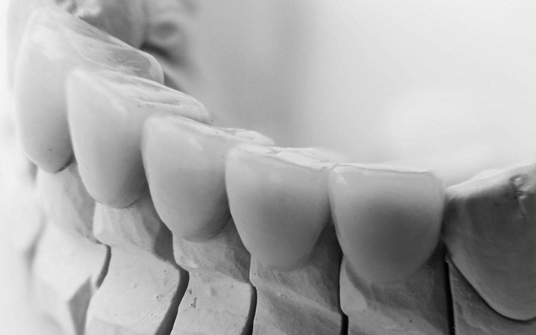 Facial Cutback Crowns