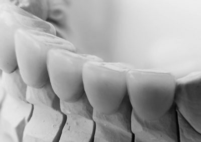 Facial Cutback Crowns