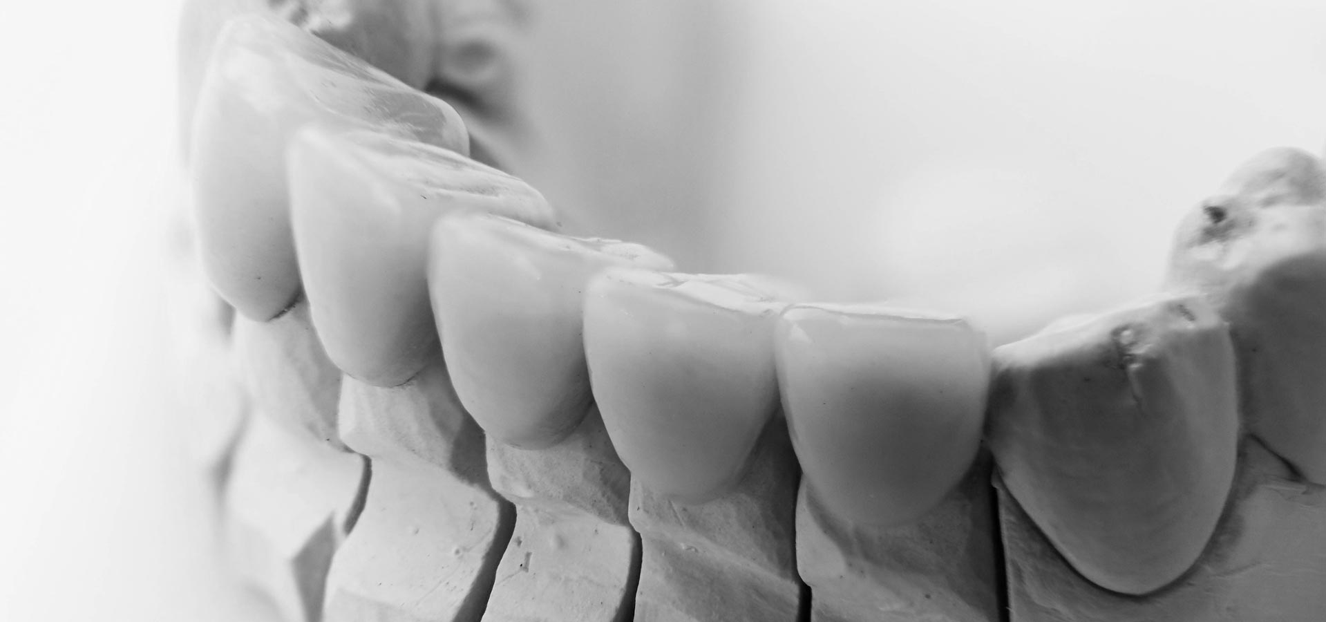 Facial Cutback Crowns