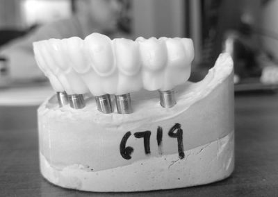 Facial Cutback Implants