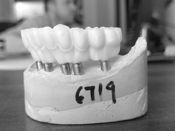 Facial Cutback Implants