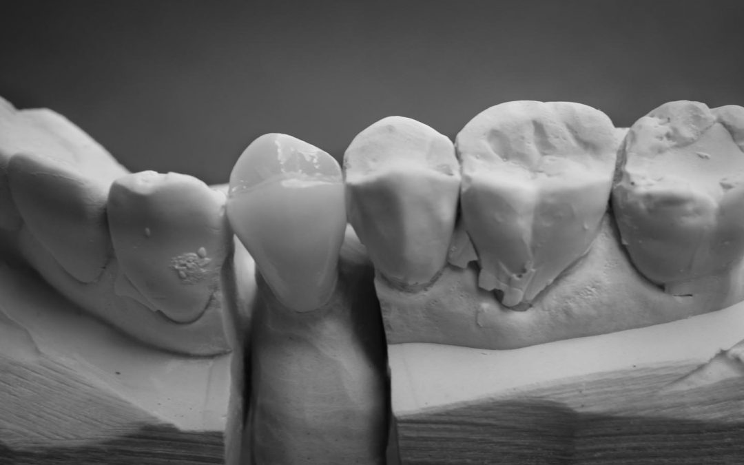 Full Anatomy Crowns