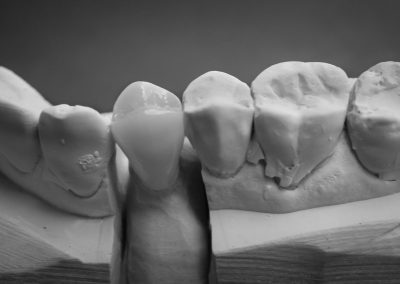Full Anatomy Crowns
