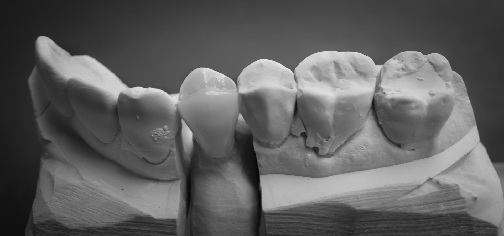Full Anatomy Crowns