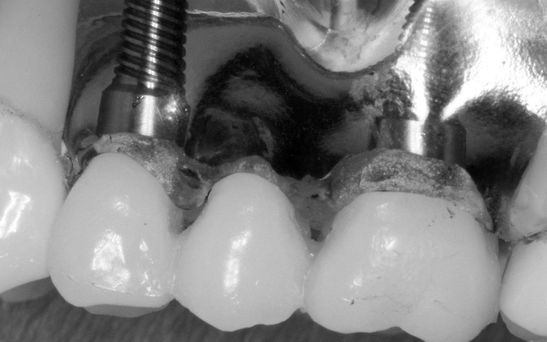 Full Anatomy Implants
