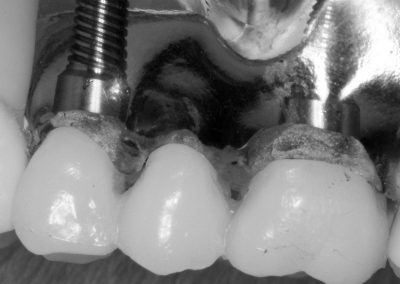 Full Anatomy Implants