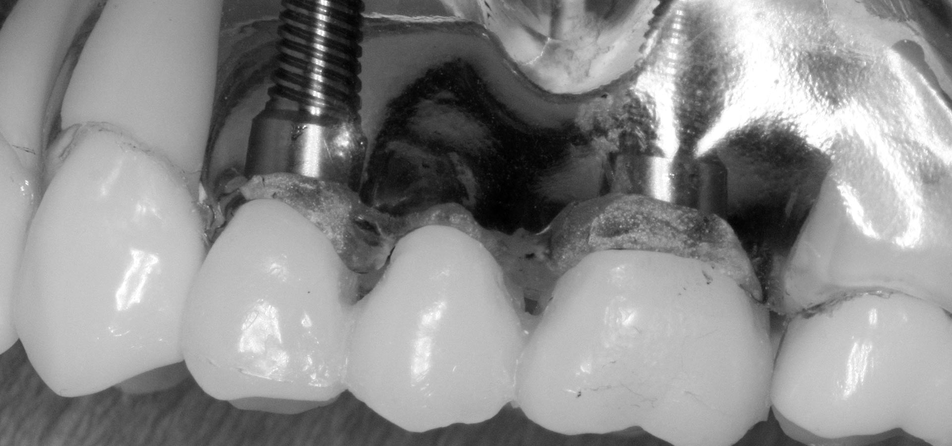 Full Anatomy Implants